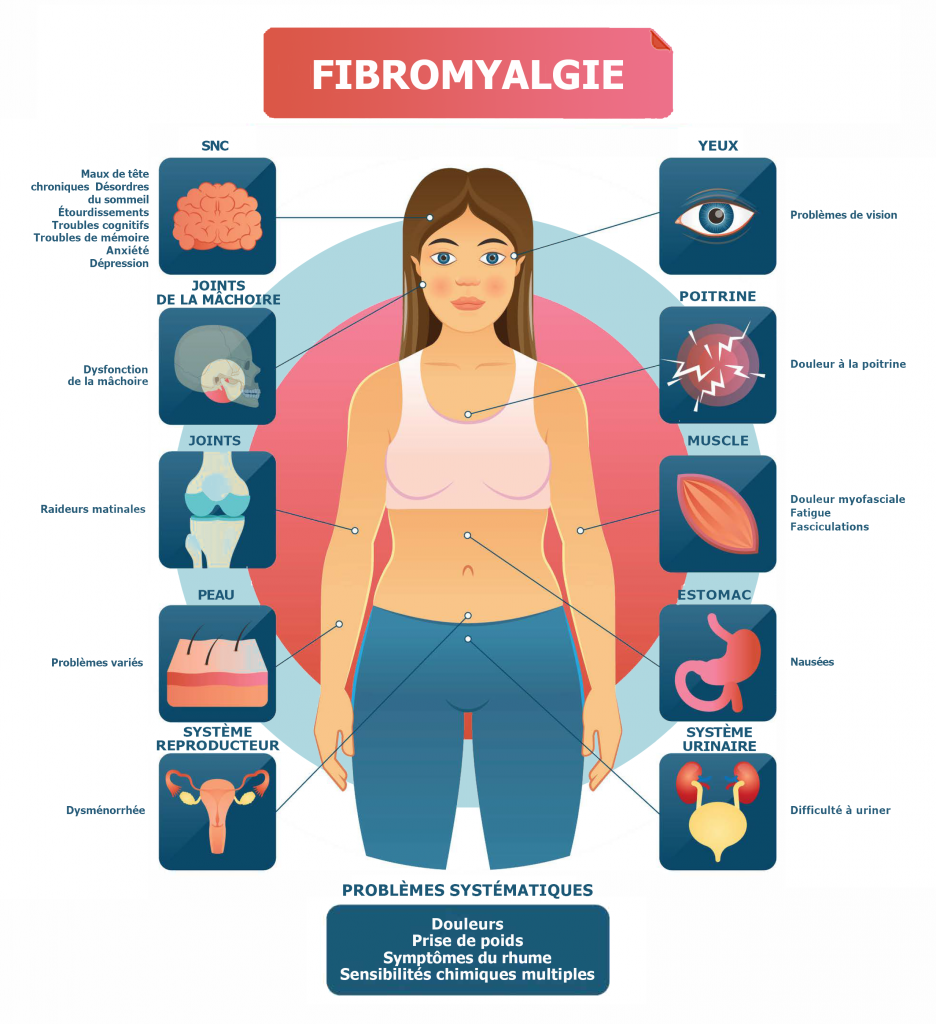 graphisme présentant les symptômes de la fibromyalgie